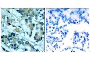 Immunohistochemical analysis of paraffin-embedded human lung carcinoma tissue, using MEK1 (Ab-217) antibody (E021203). (MEK1 anticorps)