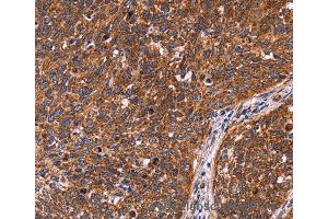 Immunohistochemistry of Human colon cancer using CCDC106 Polyclonal Antibody at dilution of 1:60 (CCDC106 anticorps)