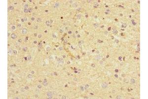 Immunohistochemistry of paraffin-embedded human glioma using ABIN7161350 at dilution of 1:100 (CHRNA9 anticorps  (AA 26-240))
