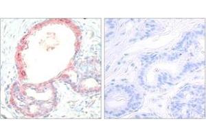 Immunohistochemistry analysis of paraffin-embedded human breast carcinoma, using Rel (Phospho-Ser503) Antibody. (c-Rel anticorps  (pSer503))