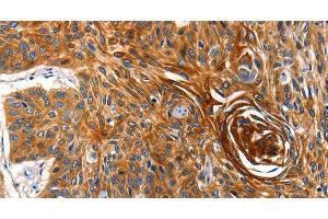 Immunohistochemistry of paraffin-embedded Human esophagus cancer tissue using AQP5 Polyclonal Antibody at dilution 1:40 (Aquaporin 5 anticorps)