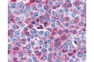 Anti-CNR1 / CB1 antibody IHC of human Lymph Node, Non-Hodgkins Lymphoma.