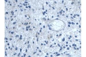 Detection of TGFbI in Human Glioma Tissue using Polyclonal Antibody to Transforming Growth Factor Beta Induced Protein (TGFbI)
