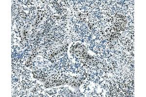 IHC analysis of MSI using anti-MSI antibody (ABIN7603130). (MSI1 anticorps  (N-Term))