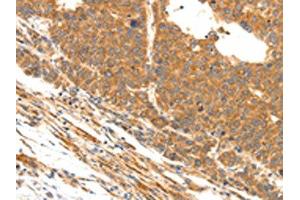 The image on the left is immunohistochemistry of paraffin-embedded Human liver cancer tissue using ABIN7190491(DOPEY1 Antibody) at dilution 1/25, on the right is treated with synthetic peptide.