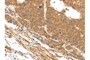 The image on the left is immunohistochemistry of paraffin-embedded Human liver cancer tissue using ABIN7190491(DOPEY1 Antibody) at dilution 1/25, on the right is treated with synthetic peptide. (DOPEY1 anticorps)