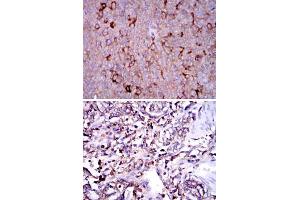 Immunohistochemical analysis of paraffin-embedded human ovarian cancer (upper) and human stomach cancer (bottom) tissues using G6PD monoclonal antibody, clone 5E12  with DAB staining.