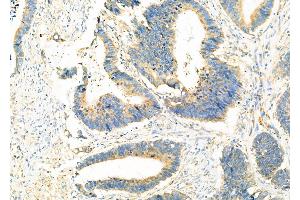 ABIN6265121 and ABIN6273320 at 1/100 staining Human colorectal cancer by IHC-P. (SLC25A46 anticorps  (N-Term))