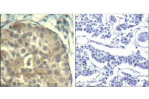 Immunohistochemical analysis of paraffin-embedded human breast carcinoma tissue using cofilin1/cofilin2 (phospho-Tyr88) Antibody (E011507). (Cofilin1/2 (CFL1/2) (pTyr88) anticorps)