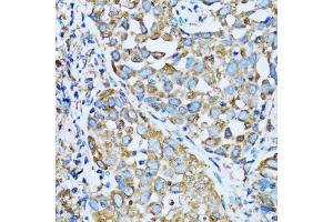 Immunohistochemistry of paraffin-embedded human lung cancer using OGDH antibody (ABIN5973793) at dilution of 1/100 (40x lens). (alpha KGDHC anticorps)