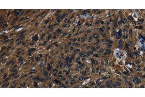 Immunohistochemistry of paraffin-embedded Human esophagus cancer using KLK14 Polyclonal Antibody at dilution of 1:40