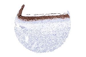 Strong CEA immunostaining of the superfical layers of the squamous epithelium of the tonsil surface.