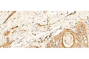 Immunohistochemistry of paraffin-embedded Human esophagus cancer tissue using EIF3C Polyclonal Antibody at dilution of 1:35(x200) (EIF3C anticorps)
