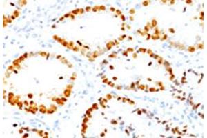 Immunohistochemical staining (Formalin-fixed paraffin-embedded sections) of human lung adenocarcinoma with NKX2-1 monoclonal antibody, clone SPM150 . (NKX2-1 anticorps)
