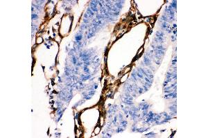 Anti- HSP27 antibody, IHC(P) IHC(P): Human Intestinal Cancer Tissue (HSP27 anticorps  (AA 1-205))