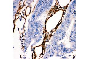 Anti- HSP27 antibody, IHC(P) IHC(P): Human Intestinal Cancer Tissue