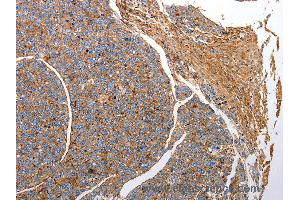 Immunohistochemistry of Human liver cancer using CD151 Polyclonal Antibody at dilution of 1:25 (CD151 anticorps)