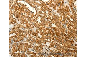 Immunohistochemistry of Human liver cancer using RAB35 Polyclonal Antibody at dilution of 1:50