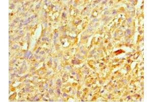 Immunohistochemistry of paraffin-embedded human melanoma using ABIN7151313 at dilution of 1:100