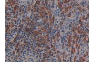 Detection of LAT2 in Human Skin cancer Tissue using Polyclonal Antibody to Linker For Activation Of T-Cells Family, Member 2 (LAT2)