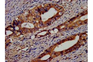 IHC image of ABIN7152156 diluted at 1:400 and staining in paraffin-embedded human colon cancer performed on a Leica BondTM system. (EIF3G anticorps  (AA 2-320))