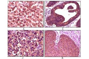 Immunohistochemical analysis of paraffin-embedded human liver tissue (A), colon carcinoma (B), lung carcinoma (C) and esophagus tissue (D), showing membrane localization using CK1 antibody with DAB staining. (CSNK1A1 anticorps)