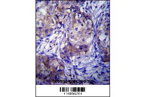 CYP1A1 Antibody immunohistochemistry analysis in formalin fixed and paraffin embedded human breast carcinoma followed by peroxidase conjugation of the secondary antibody and DAB staining.