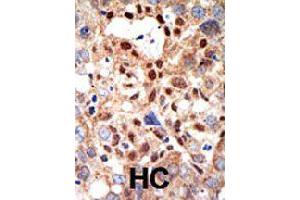Formalin-fixed and paraffin-embedded human hepatocellular carcinoma tissue reacted with PML polyclonal antibody  , which was peroxidase-conjugated to the secondary antibody, followed by DAB staining . (PML anticorps)
