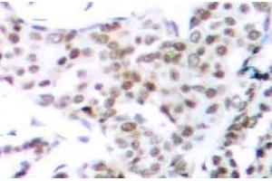 Immunohistochemistry (IHC) analyzes of p-STAT3 (pSer727) pAb in paraffin-embedded human breast carcinoma tissue. (STAT3 anticorps  (pSer727))