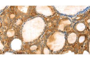 Immunohistochemistry of paraffin-embedded Human thyroid cancer using TMPRSS11F Polyclonal Antibody at dilution of 1:30 (TMPRSS11F anticorps)