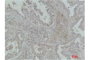Immunohistochemistry (IHC) analysis of paraffin-embedded Human Lung Carcinoma using MICU1 Monoclonal Antibody. (MICU1 anticorps)