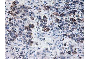 Immunohistochemical staining of paraffin-embedded Carcinoma of Human lung tissue using anti-PDE4B mouse monoclonal antibody. (PDE4B anticorps)