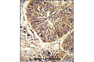 Formalin-fixed and paraffin-embedded human lung carcinoma reacted with PDIA3 Antibody (C-term), which was peroxidase-conjugated to the secondary antibody, followed by DAB staining.