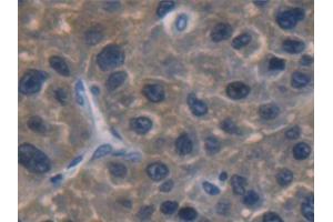 Detection of ALDH1A1 in Human Liver cancer Tissue using Polyclonal Antibody to Aldehyde Dehydrogenase 1 Family, Member A1 (ALDH1A1)