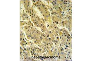 PSG7 Antibody IHC analysis in formalin fixed and paraffin embedded hepatocarcinoma followed by peroxidase conjugation of the secondary antibody and DAB staining. (PSG7 anticorps  (C-Term))
