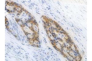 ABIN6264918 and ABIN6277937 at 1/100 staining human pancreatic carcinoma by IHC-P. (SALL4 anticorps  (Internal Region))