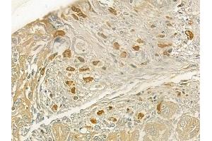 ABIN6258755 and ABIN6273696 at 1/100 staining human tongue carcinoma by IHC-P. (SETDB2 anticorps  (N-Term))