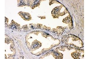 IHC testing of FFPE human prostate cancer with DBI antibody at 1ug/ml.