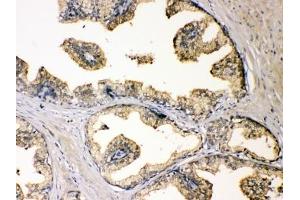 IHC testing of FFPE human prostate cancer with DBI antibody at 1ug/ml. (Diazepam Binding Inhibitor anticorps  (AA 2-187))