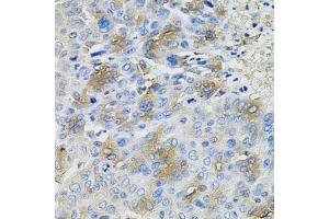 Immunohistochemistry of paraffin-embedded human liver cancer using SERPINA1 antibody. (SERPINA1 anticorps  (AA 25-315))