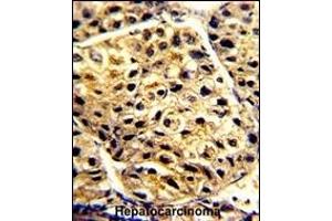 Formalin-fixed and paraffin-embedded human hepatocarcinoma with DAC Antibody (C-term), which was peroxidase-conjugated to the secondary antibody, followed by DAB staining.