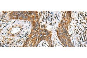 Immunohistochemistry of paraffin-embedded Human esophagus cancer tissue using TTR Polyclonal Antibody at dilution of 1:50(x200) (TTR anticorps)