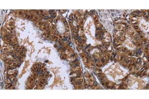 Immunohistochemistry of paraffin-embedded Human esophagus cancer using LTA4H Polyclonal Antibody at dilution of 1:30 (LTA4H anticorps)