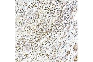 Immunohistochemistry of paraffin-embedded human liver cancer using TCF1/TCF7 Rabbit mAb (ABIN7270885) at dilution of 1:100 (40x lens).