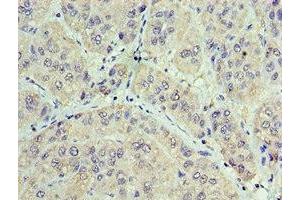 Immunohistochemistry of paraffin-embedded human liver cancer using ABIN7153848 at dilution of 1:100 (GAN anticorps  (AA 1-240))