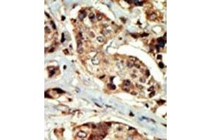 Formalin-fixed and paraffin-embedded human cancer tissue (breast carcinoma) reacted with the primary antibody, which was peroxidase-conjugated to the secondary antibody, followed by DAB staining.