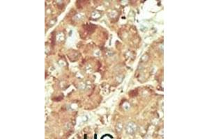 Formalin-fixed and paraffin-embedded human cancer tissue reacted with the primary antibody, which was peroxidase-conjugated to the secondary antibody, followed by DAB staining.