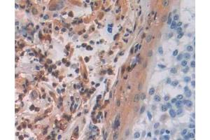 DAB staining on IHC-P; Samples: Human Skin cancer Tissue (MAEA anticorps  (AA 136-379))