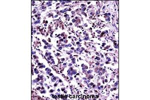 CN11 Antibody (Center) (13870c)immunohistochemistry analysis in formalin fixed and paraffin embedded human testis carcinoma followed by peroxidase conjugation of the secondary antibody and DAB staining. (CAPN11 anticorps  (AA 409-438))