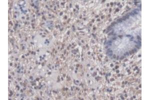 DAB staining on IHC-P; Samples: Human Colorectal cancer Tissue (PTTG1 anticorps  (AA 2-202))
